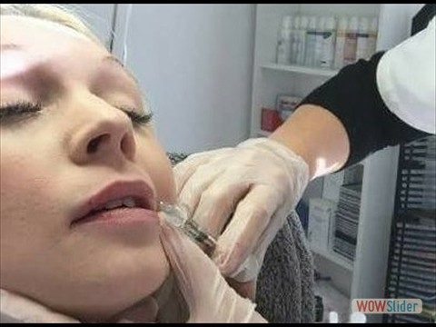 Faltenunterspritzung